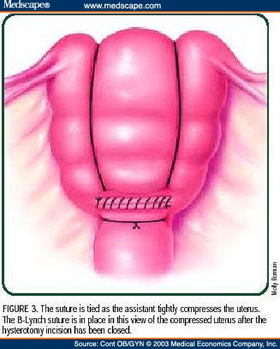 Uterine compression sutures for postpartum hemorrhage: an 